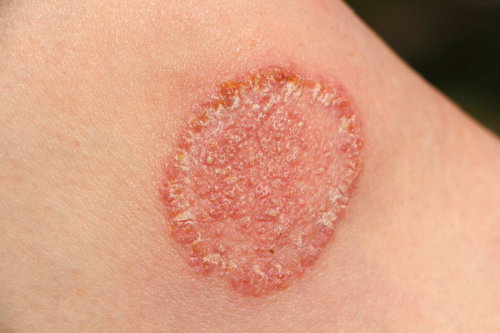 Fungal Infection Treatment in Jp Nagar