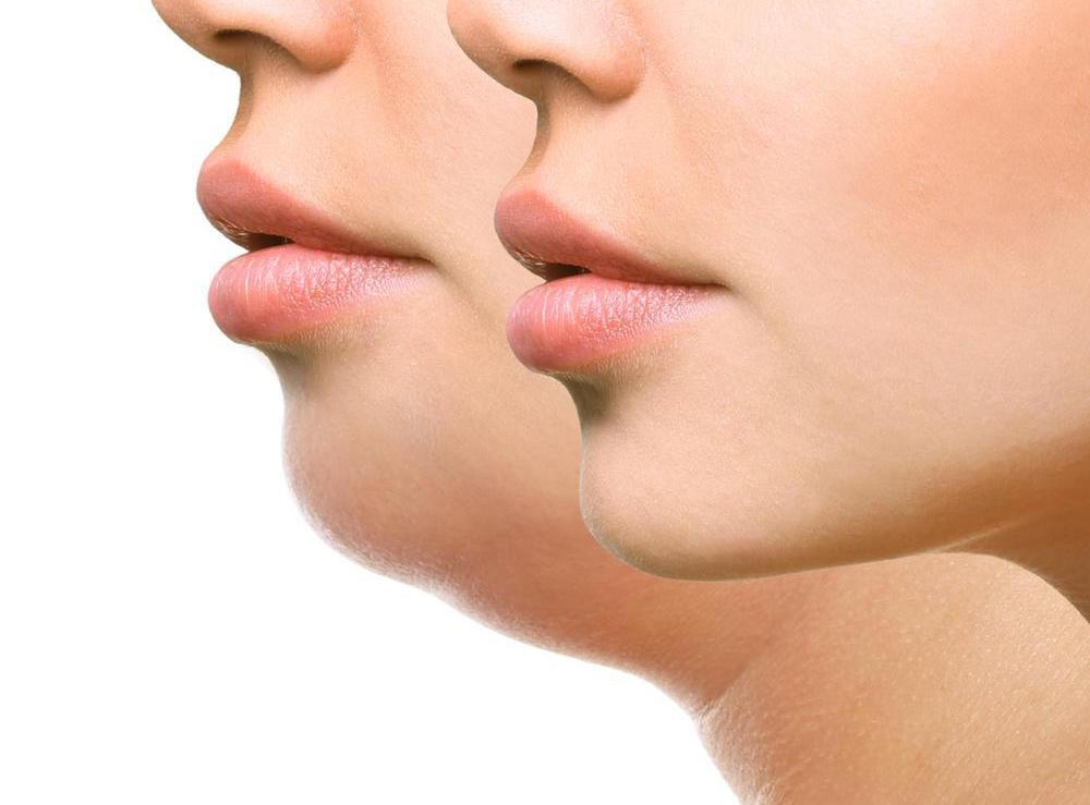 Non-Surgical Facelift treatment in Bangalore