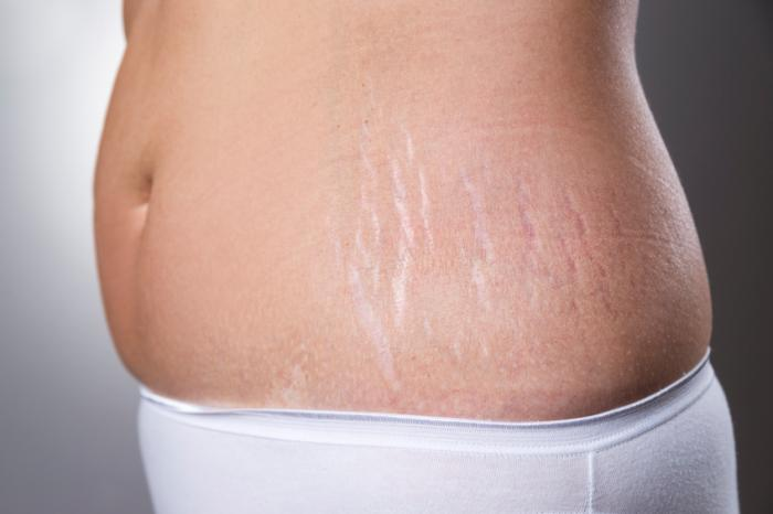Stretch Marks Removal Treatment In Jp Nagar